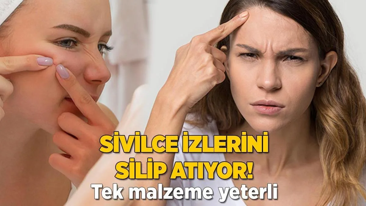 sivilce izlerini tekte silip atiyormus tek gerecte mucize tesir 7dkvCUP8 jpg