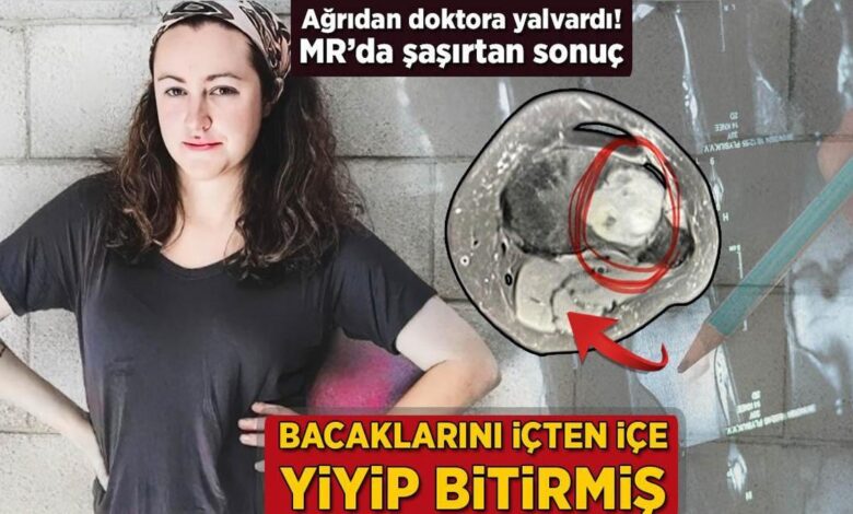 bacaklarini icten ice yiyip bitirmis agridan doktora yalvardi mrda sasirtan sonuc 8wri2IjL