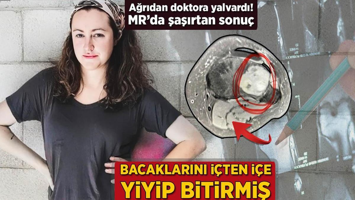 Bacaklarını içten içe yiyip bitirmiş! Ağrıdan doktora yalvardı, MR’da şaşırtan sonuç