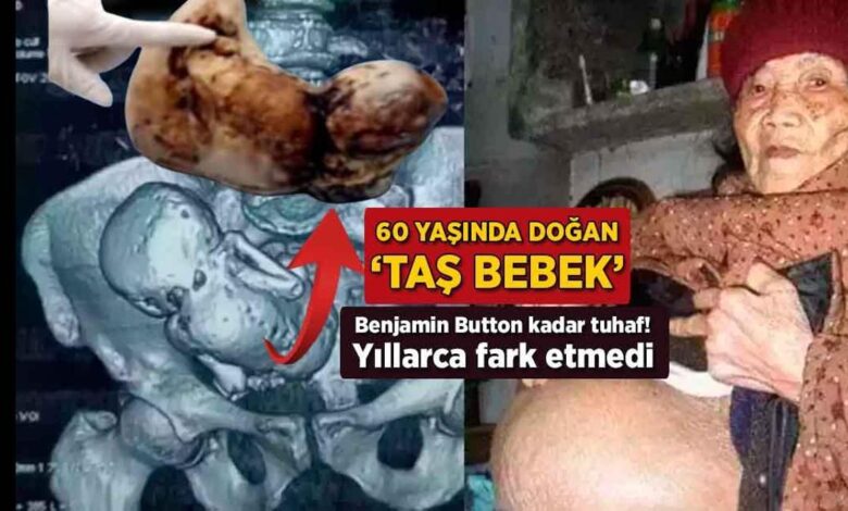 Benjamin Button kadar tuhaf, yıllarca fark etmedi! 60 yaşında doğan 'taş bebek' 1 benjamin button kadar tuhaf yillarca fark etmedi 60 yasinda dogan tas bebek dKSNUmXu