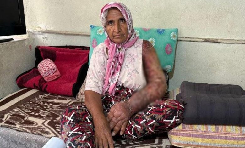 Her şey 8 yıl evvel başladı! Kolu şişti, bedenine kadar yayıldı 1 her sey 8 yil evvel basladi kolu sisti bedenine kadar yayildi nPgQGjsm