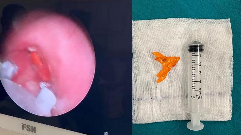 Nefes borusuna şeker ambalajı kaçtı! 10 aylık bebek vefattan döndü 2 nefes borusuna seker ambalaji kacti 10 aylik bebek vefattan dondu 0 hhVcCWky