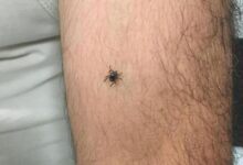 panik buyuyor bir ilcede daha kene olayi goruldu 9GlKvYeh