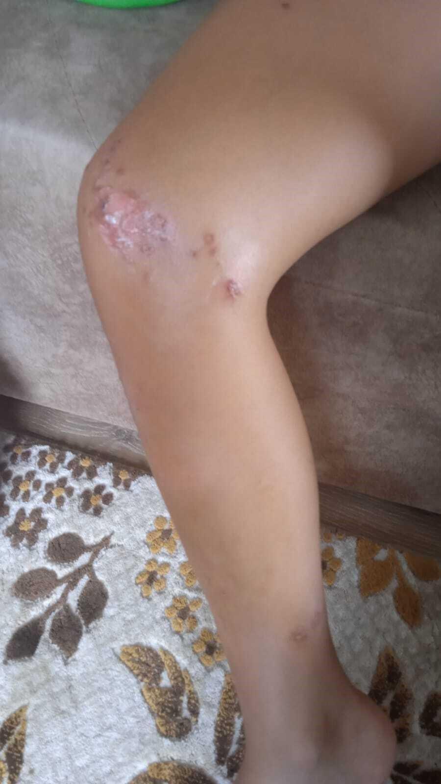 9 yaşındaki çocuk denizden çıktıktan sonra fenalaştı! Bedeninde çıkan lekelerle ilgili fecî kuşku 4 9 yasindaki cocuk denizden ciktiktan sonra fenalasti bedeninde cikan lekelerle ilgili fec kusku 2 nwl8vYdS