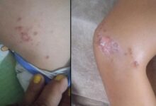 9 yasindaki cocuk denizden ciktiktan sonra fenalasti bedeninde cikan lekelerle ilgili fec kusku wV4F3RRV
