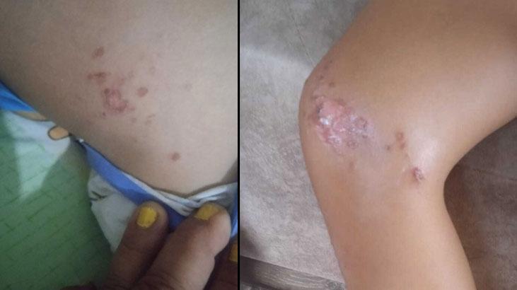 9 yaşındaki çocuk denizden çıktıktan sonra fenalaştı! Bedeninde çıkan lekelerle ilgili fecî kuşku 1 9 yasindaki cocuk denizden ciktiktan sonra fenalasti bedeninde cikan lekelerle ilgili fec kusku wV4F3RRV