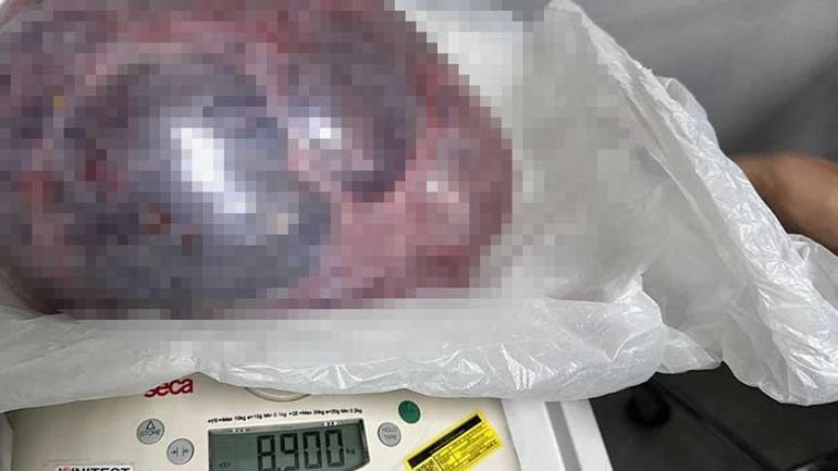 ameliyat masasinda buyuk sok 9 kilo tartisinda kile cikartildi 0