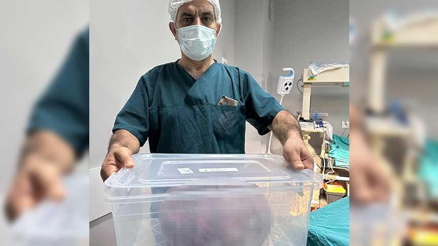 Ameliyat masasında büyük şok! 9 kilo tartısında kile çıkartıldı