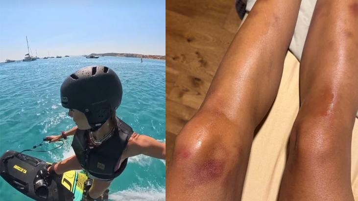 Çağla Şıkel'in bacakları mosmor oldu! Nedeni ise yeni hobisi: En hoş yaz 6 cagla sikelin bacaklari mosmor oldu nedeni ise yeni hobisi en hos yaz 4 pvJYGmQF
