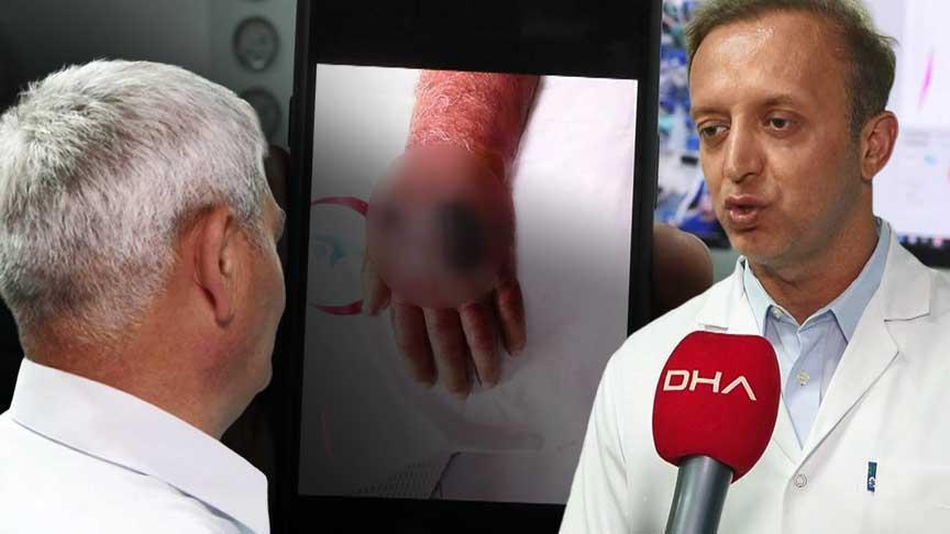 Elini ısıran hırsız yüzünden kolu kesilecekti! Tabipler şaşkın: Bizim için de birinci oldu, literatüre girecek