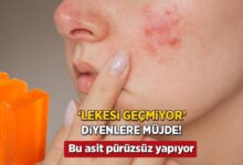 sivilcem gecti lakin iz kaldi diyenlere mujde japon sabunu lekeleri silip supuruyor VWt8YMTW