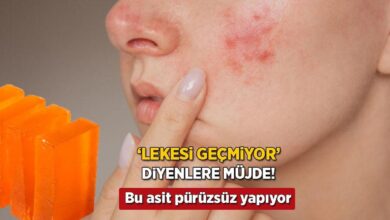 sivilcem gecti lakin iz kaldi diyenlere mujde japon sabunu lekeleri silip supuruyor VWt8YMTW