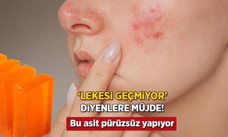 'Sivilcem geçti lakin iz kaldı' diyenlere müjde! Japon sabunu lekeleri silip süpürüyor 1 sivilcem gecti lakin iz kaldi diyenlere mujde japon sabunu lekeleri silip supuruyor VWt8YMTW