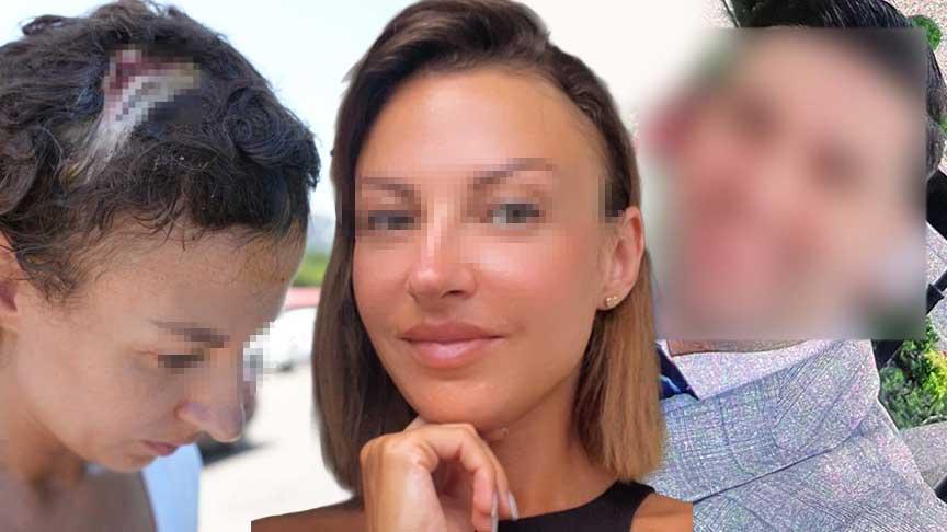 Uzaklaştırma kararı sonrası vahşet! Kafatasına zımba atıldı, elleri kırıldı: Plan yapıp beni öldürmeye geldi