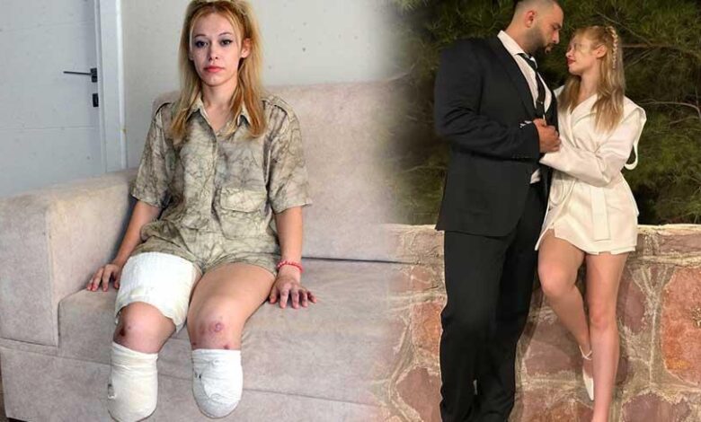 Fitness eğitmeni en keyifli gününde 2 bacağını kaybetti! ‘Evlilik yıl dönümüm cehenneme döndü’ 1 fitness egitmeni en keyifli gununde 2 bacagini kaybetti evlilik yil donumum cehenneme dondu 2mW1SJgc