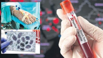 turkiyede mpox argumani fLKRnz3T