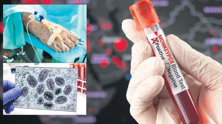 Türkiye’de ‘mpox’ argümanı 1 turkiyede mpox argumani fLKRnz3T